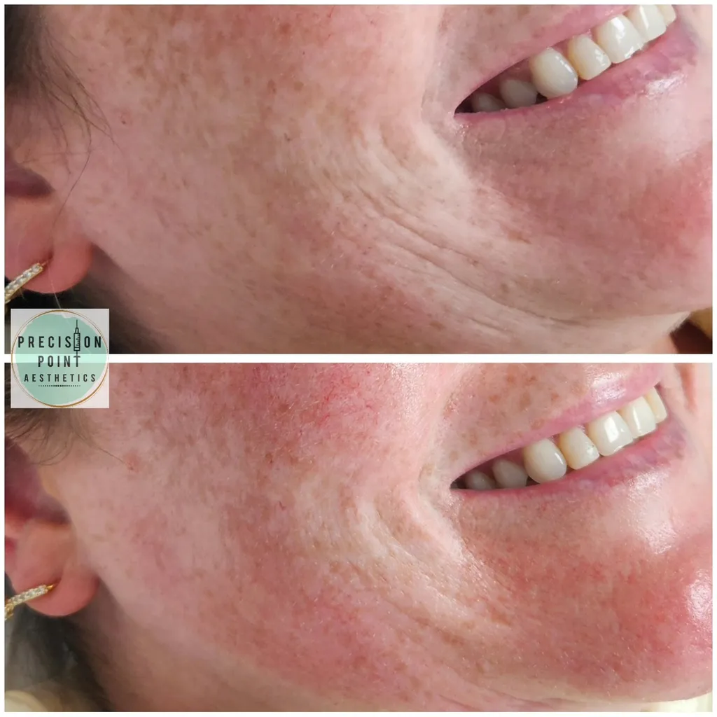 Derma 2.0 Treatment