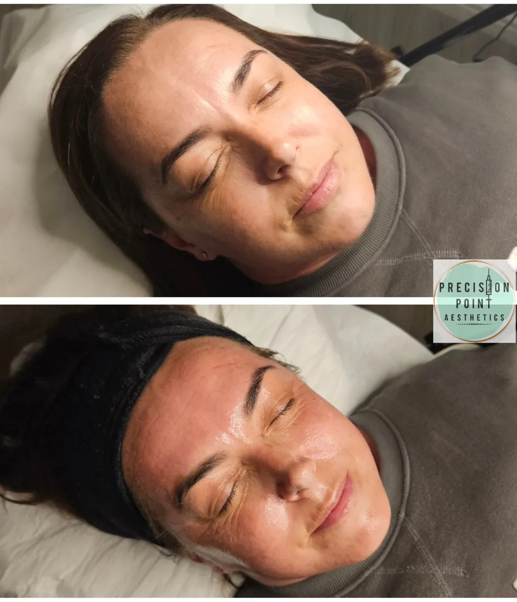 Dermaplaning & Chemical Peel Facial